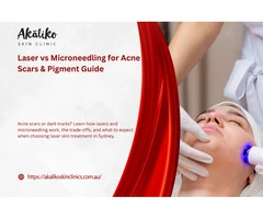 Laser vs Microneedling for Acne Scars & Pigment Guide