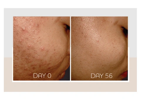 Acne Treatments Bankstown | Clear, Healthy Skin at OC Skin Bankstown