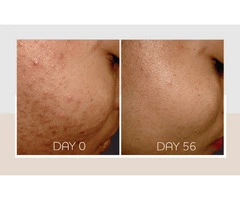 Acne Treatments Bankstown | Clear, Healthy Skin at OC Skin Bankstown