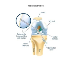 Restore Stability with torn ACL (Anterior Cruciate Ligament) surgery