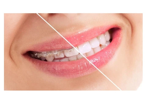 Braces Zetland - Orthoworx