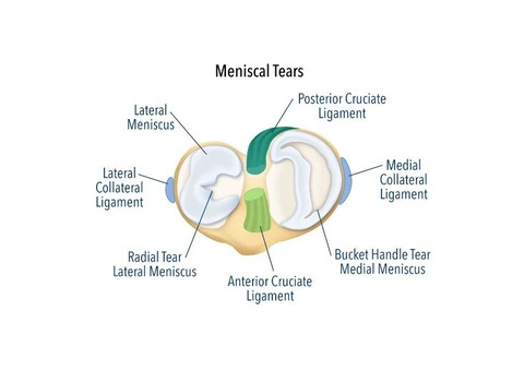Relieve Knee Pain with Medial Meniscus Tear Surgery