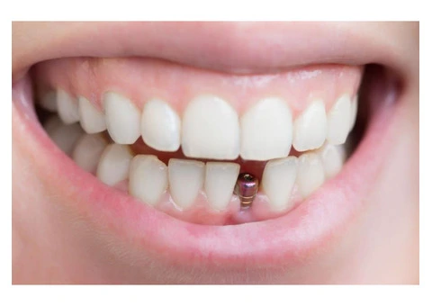 Dental implants perth