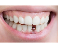 Dental implants perth