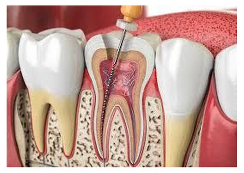 Dental Pulp Treatment: Expert Care for Sensitive Teeth