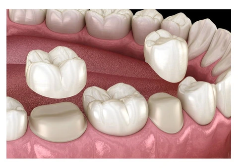 Tooth Cap Treatment for Broken and Damaged Teeth