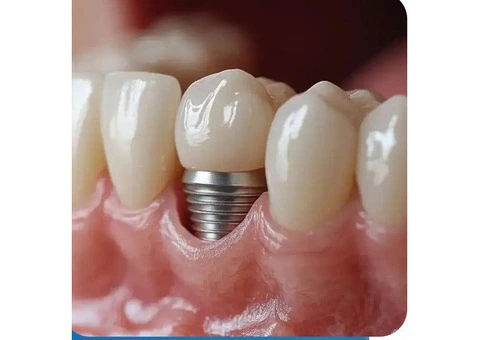 Dental Implants Penrith