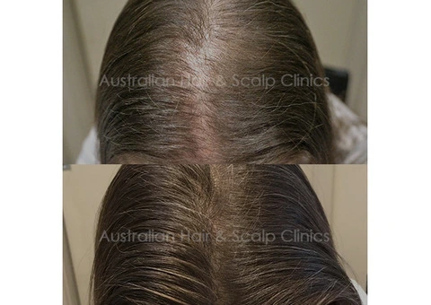 Hair Treatment Brisbane for Hair Health Support