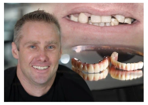 Why Are All On 4 Dental Implants Melbourne a Popular Choice?