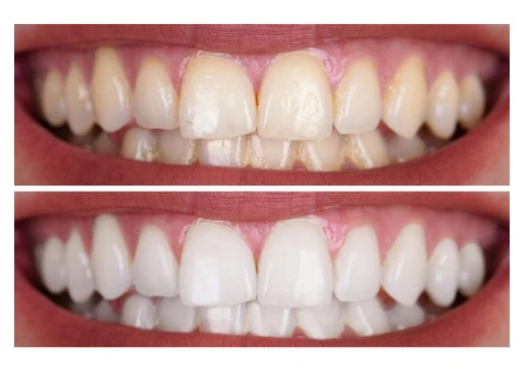 Tooth Bleaching Solutions With Professional Dental Support