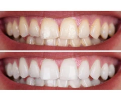 Tooth Bleaching Solutions With Professional Dental Support