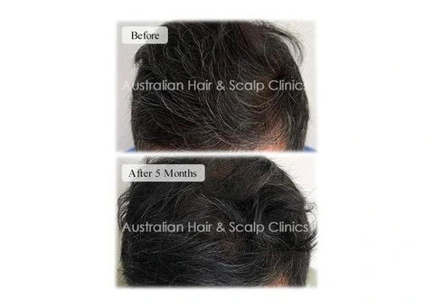 Hairpieces for Men with Natural Appearance