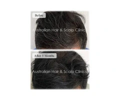 Hairpieces for Men with Natural Appearance