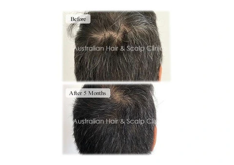 Anti-Dandruff Treatment for a Healthy Scalp