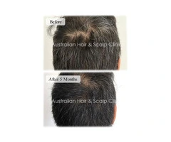 Anti-Dandruff Treatment for a Healthy Scalp