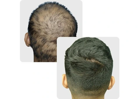Regrow Confidence with Expert Hair Replacement Perth