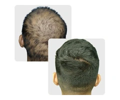 Regrow Confidence with Expert Hair Replacement Perth