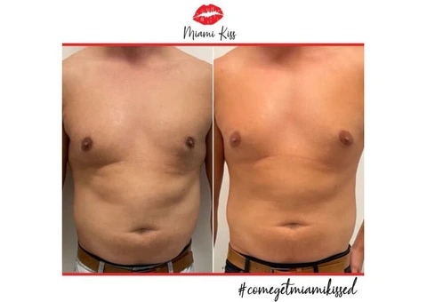 Fat Freezing Near Me in Varsity Lakes – Safe & Effective Body Sculpting - 1/6