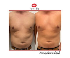 Fat Freezing Near Me in Varsity Lakes – Safe & Effective Body Sculpting