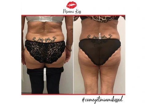 Fat Freezing Near Me in Varsity Lakes – Safe & Effective Body Sculpting - 2/6