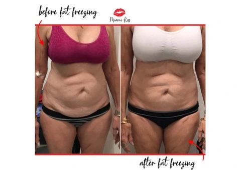 Fat Freezing Near Me in Varsity Lakes – Safe & Effective Body Sculpting - 3/6