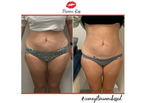 Fat Freezing Near Me in Varsity Lakes – Safe & Effective Body Sculpting - 4/6