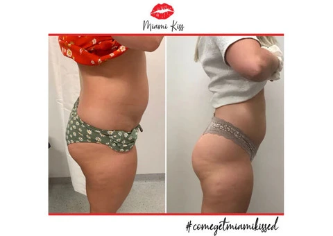 Fat Freezing Near Me in Varsity Lakes – Safe & Effective Body Sculpting - 6/6