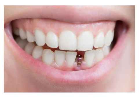 Dental implants perth