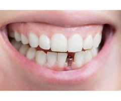 Dental implants perth
