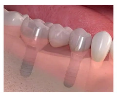 Permanent Teeth Replacement: Advanced Implants at Best Prices