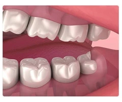 Extraction of Impacted Molars: Safe and Affordable Treatment