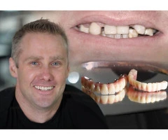 Get Affordable Implants with Cheapest All On 4 Melbourne