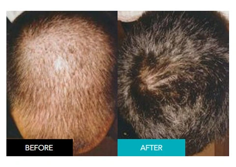 Perth’s Leading Non-Surgical Integrated Hair System for Men