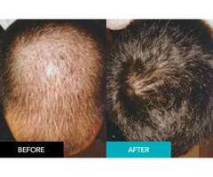 Perth’s Leading Non-Surgical Integrated Hair System for Men