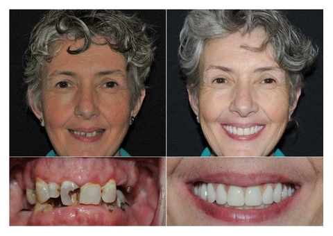 All on 4 Dental Implants Sydney | Expert Clinic Care
