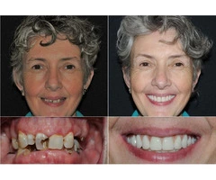 All on 4 Dental Implants Sydney | Expert Clinic Care