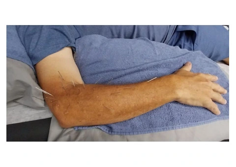 Dry Needling Near Me – Reduce Pain & Muscle Tension | Strength Clinic