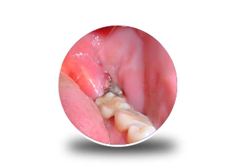 How Wisdom Teeth Infection Removal Helps Pain Fast
