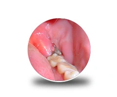 How Wisdom Teeth Infection Removal Helps Pain Fast