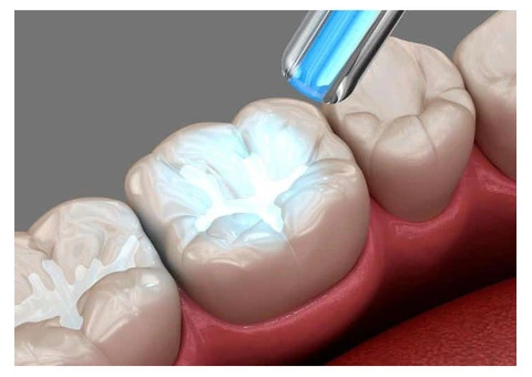 White Tooth Fillings Bexley | Natural Dental White Filling
