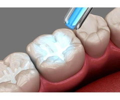 White Tooth Fillings Bexley | Natural Dental White Filling