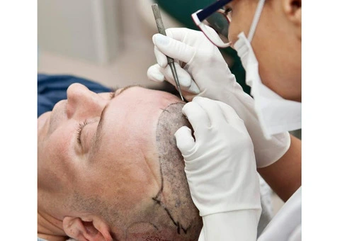 Affordable Hair Transplant in Turkey with Innovative Hair Loss Solutions