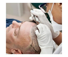 Affordable Hair Transplant in Turkey with Innovative Hair Loss Solutions