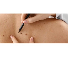 Explore Keloid Scar Treatment Procedures Assessed by Qualified Practitioners