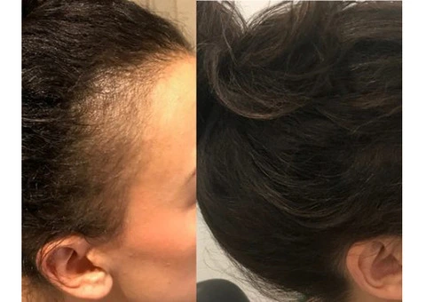 Hair Regrowth Treatment in Perth with Practical Care Plans