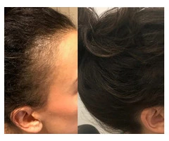 Hair Regrowth Treatment in Perth with Practical Care Plans