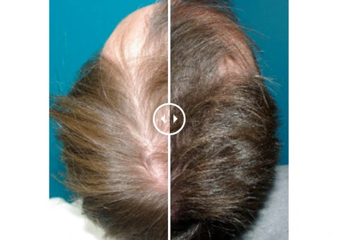 See Real Client Transformations at a Top Hair Loss Clinic Perth
