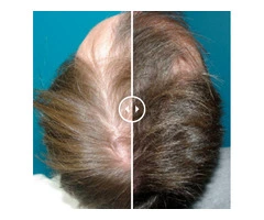 See Real Client Transformations at a Top Hair Loss Clinic Perth