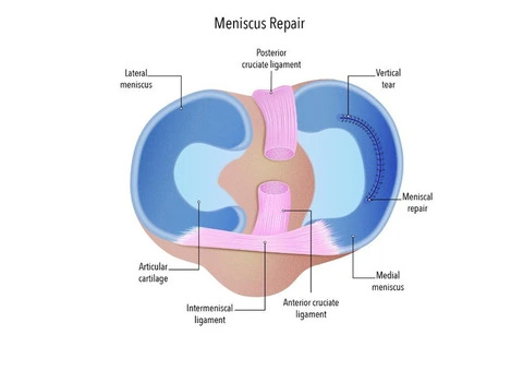 Ease Knee Pain with Reliable Meniscal Repair