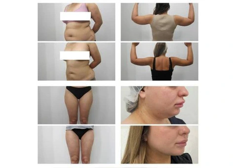 VASER Liposuction Clinic Sydney | Advanced Body Contouring Solutions - 1/3